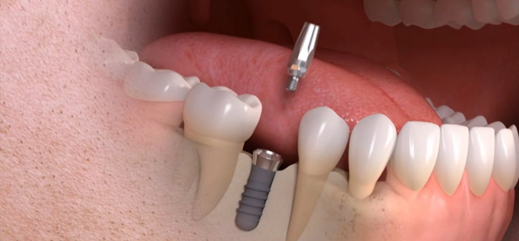 Unterschiede bei Zahnimplantaten