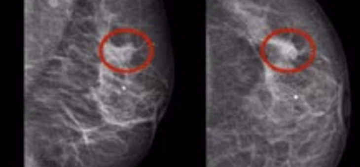 Mammografie-Screening